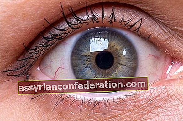 Le allergie oculari possono causare la perdita degli occhi se non trattate